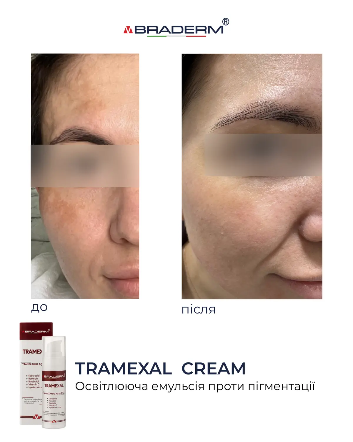 Освітлюючий крем проти пігментації Braderm Tramexal Cream 30 ml