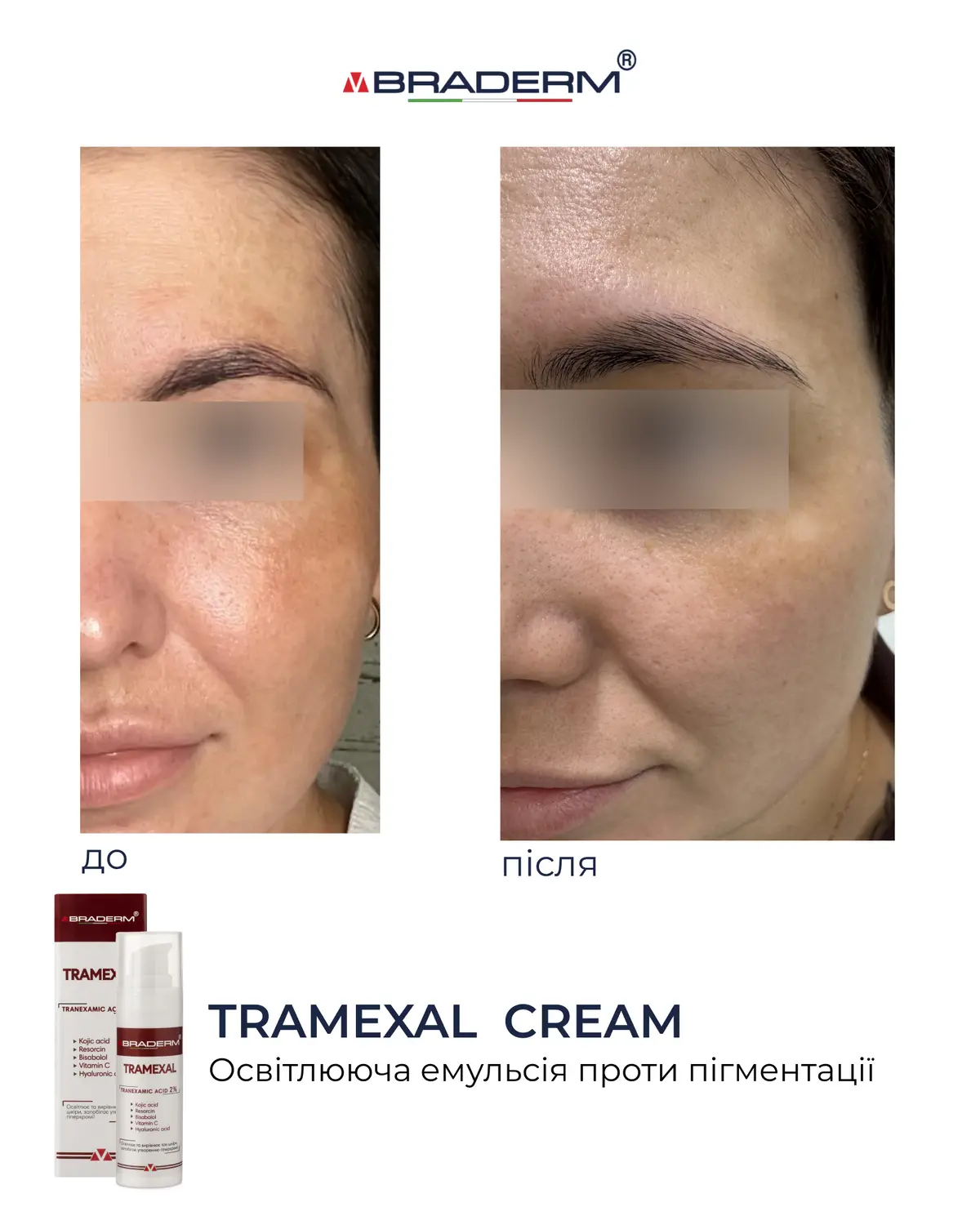 Освітлюючий крем проти пігментації Braderm Tramexal Cream 30 ml