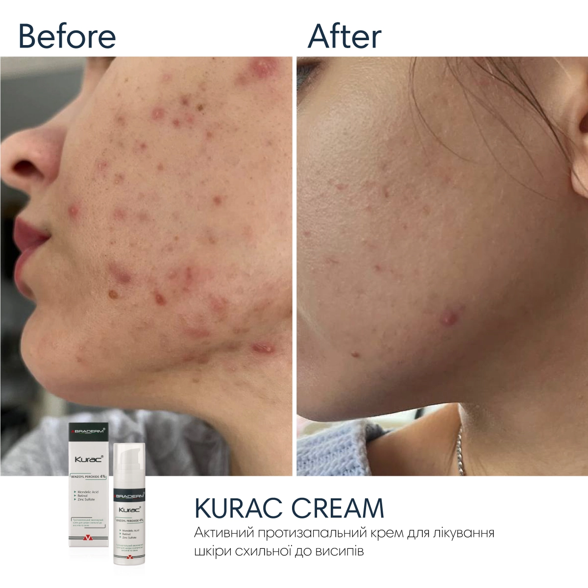 Активний протизапальний крем з бензоїл пероксидом 4% Braderm - Kurac Cream (Курак крем) 30 ml