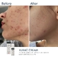 Активний протизапальний крем з бензоїл пероксидом 4% Braderm - Kurac Cream (Курак крем) 30 ml