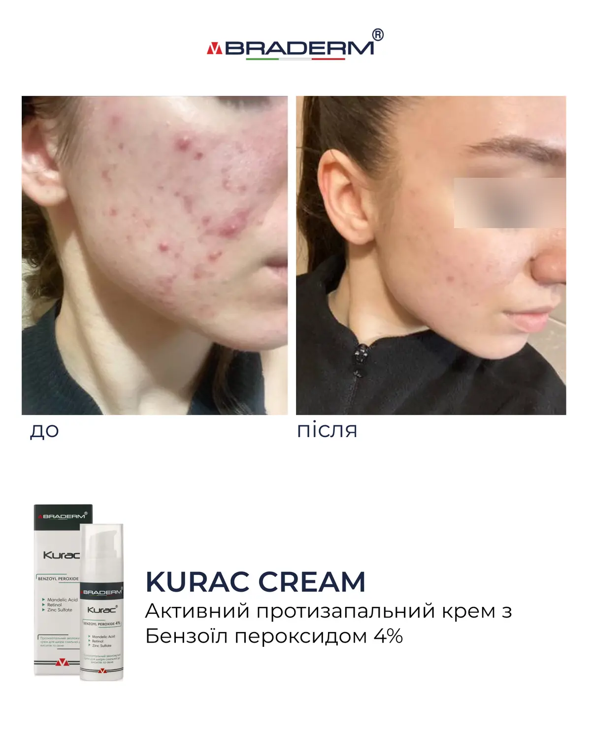 Активний протизапальний крем з бензоїл пероксидом 4% Braderm - Kurac Cream (Курак крем) 30 ml
