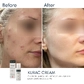 Активний протизапальний крем з бензоїл пероксидом 4% Braderm - Kurac Cream (Курак крем) 30 ml