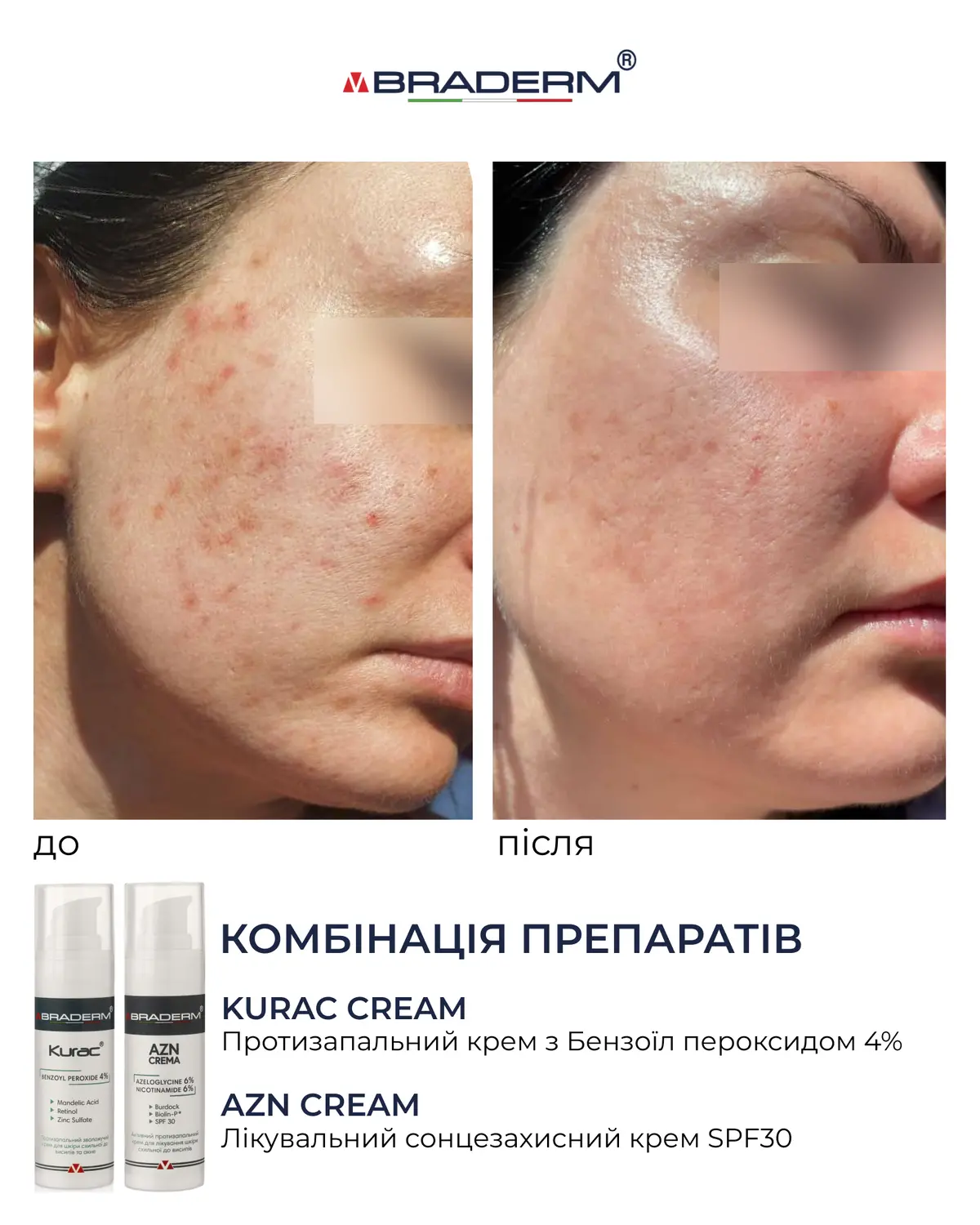 Активний протизапальний крем з бензоїл пероксидом 4% Braderm - Kurac Cream (Курак крем) 30 ml
