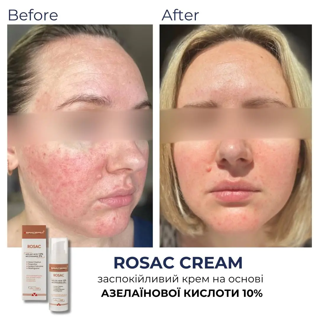 Заспокійливий крем для чутливої шкіри Braderm Rosac Cream (Розак Крем) 30 ml