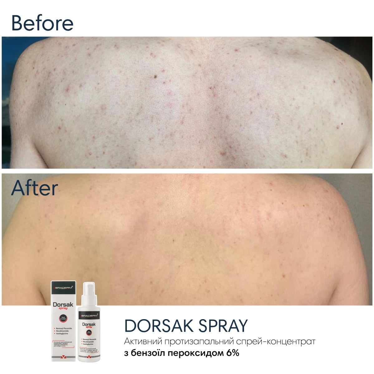 Активний протизапальний спрей з Бензоїл пероксидом 6% Braderm Dorsak Spray (Дорсак спрей) 100 ml
