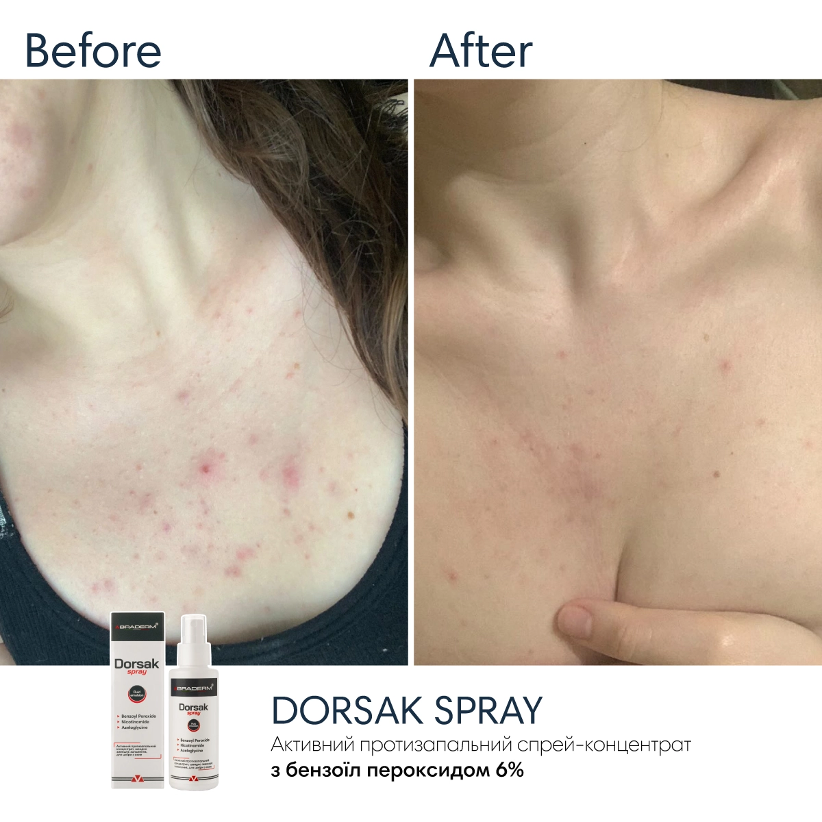 Активний протизапальний спрей з Бензоїл пероксидом 6% Braderm Dorsak Spray (Дорсак спрей) 100 ml