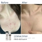 Активний протизапальний спрей з Бензоїл пероксидом 6% Braderm Dorsak Spray (Дорсак спрей) 100 ml